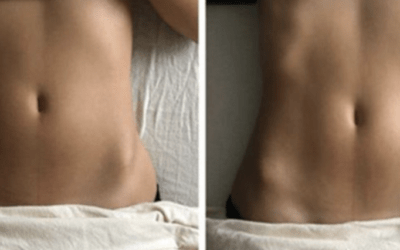 lymphatic Drainage